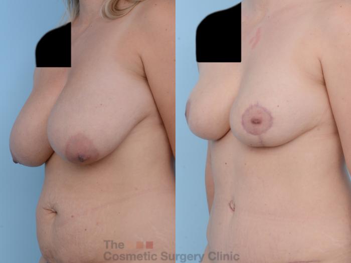 Before & After Breast Reduction Case 280 View #3 View in Waterloo, Ontario