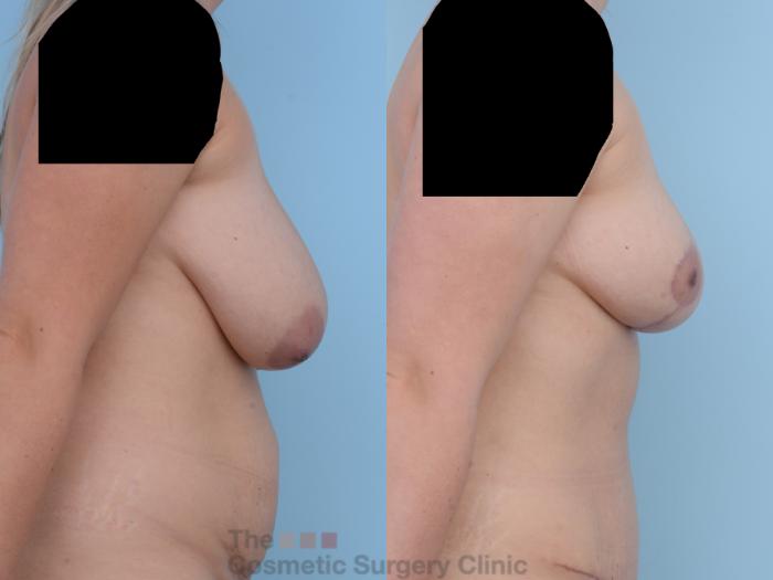 Before & After Breast Reduction Case 280 View #4 View in Waterloo, Ontario