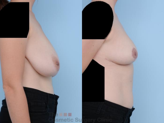 Before & After Breast Reduction Case 325 View #5 View in Waterloo, Ontario