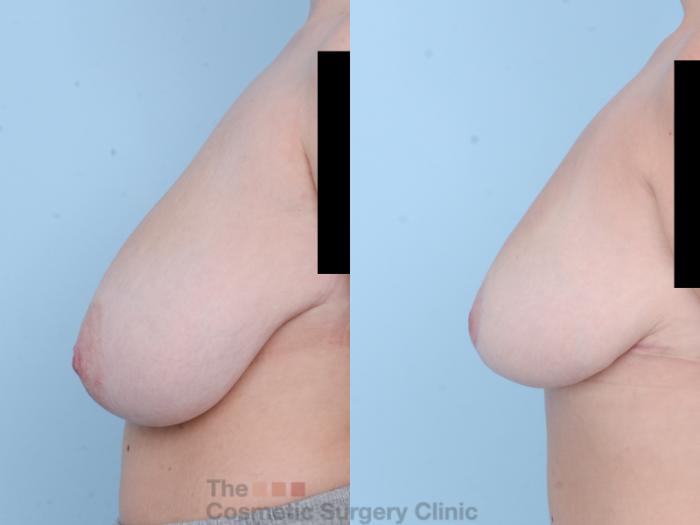 Before & After Breast Reduction Case 616 View #2 View in Waterloo, Ontario