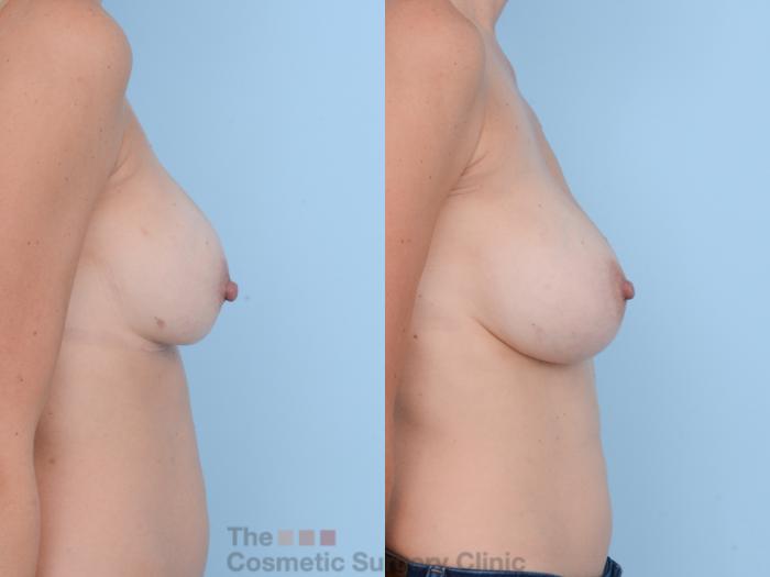 Before & After Breast Revision / Implant Removal Case 395 View #2 View in Waterloo, Ontario
