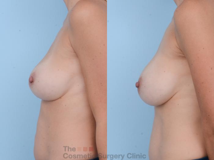 Before & After Breast Revision / Implant Removal Case 395 View #5 View in Waterloo, Ontario