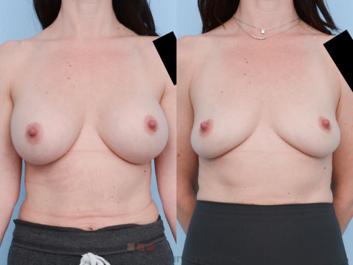 Before & After Breast Revision / Implant Removal Case 649 View #1 View in Waterloo, Ontario