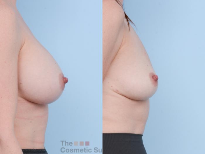 Before & After Breast Revision / Implant Removal Case 649 View #3 View in Waterloo, Ontario