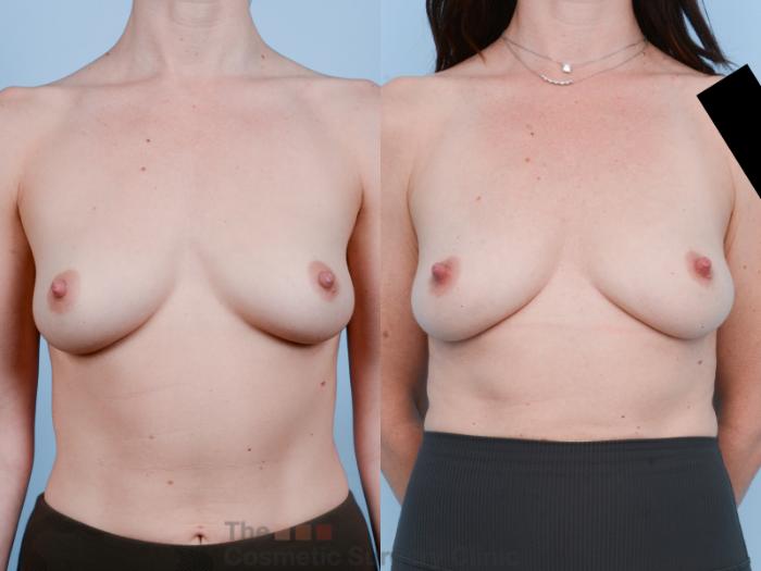 Before & After Breast Revision / Implant Removal Case 649 View #4 View in Waterloo, Ontario