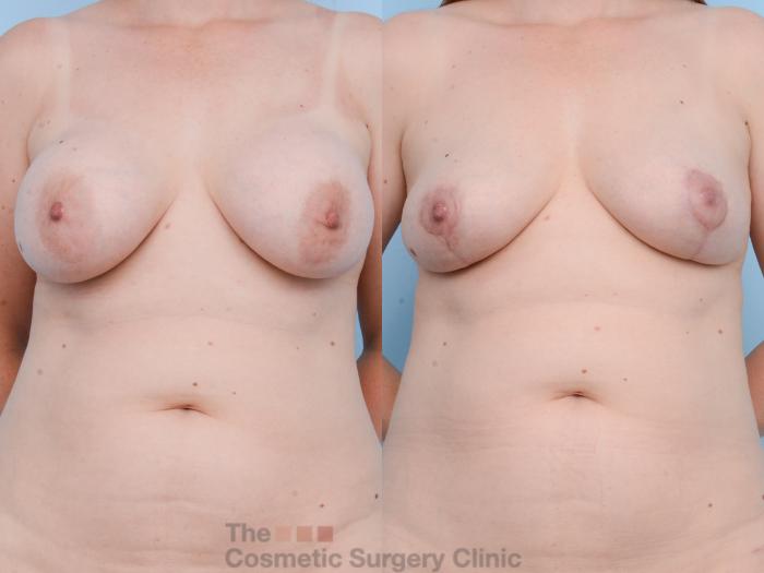 Before & After Breast Revision / Implant Removal Case 750 Front View in Waterloo, Ontario