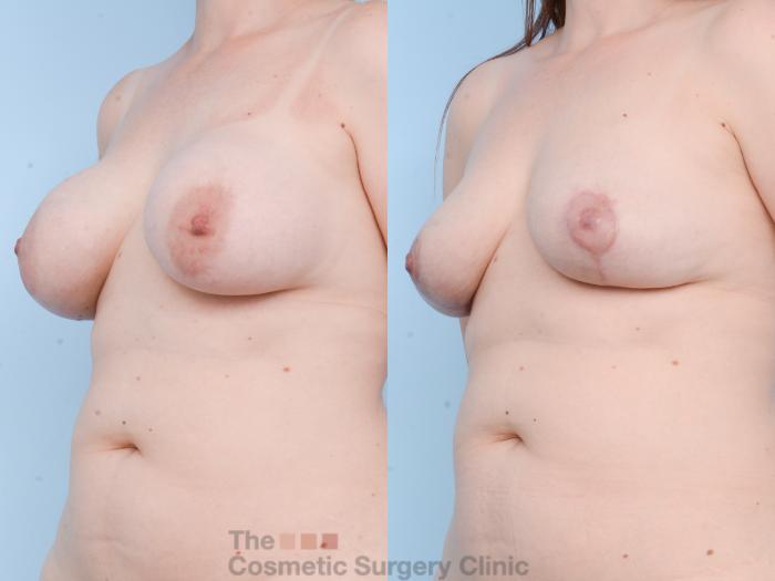 Before & After Breast Revision / Implant Removal Case 750 Left Oblique View in Waterloo, Ontario
