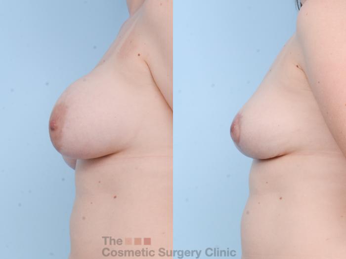 Before & After Breast Revision / Implant Removal Case 750 Left Side View in Waterloo, Ontario