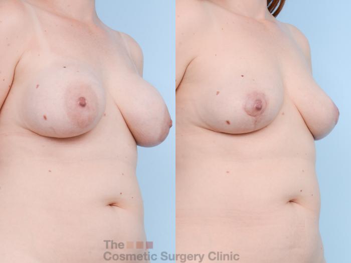 Before & After Breast Revision / Implant Removal Case 750 Right Oblique View in Waterloo, Ontario