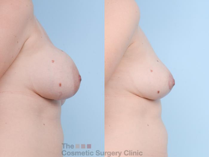Before & After Breast Revision / Implant Removal Case 750 Right Side View in Waterloo, Ontario