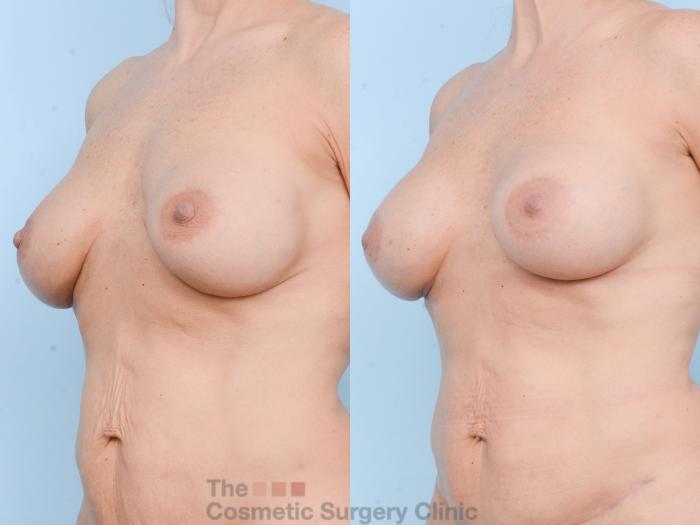 Before & After Breast Revision / Implant Removal Case 802 Left Oblique View in Waterloo, Ontario