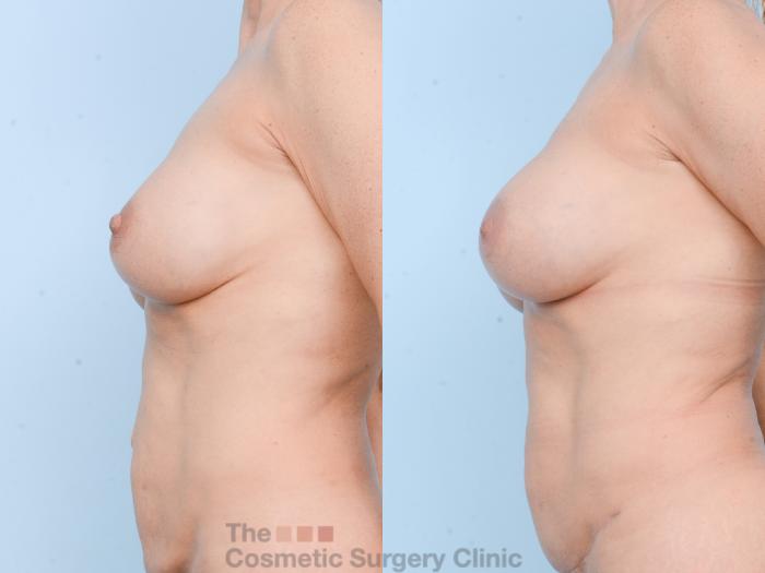 Before & After Breast Revision / Implant Removal Case 802 Left Side View in Waterloo, Ontario