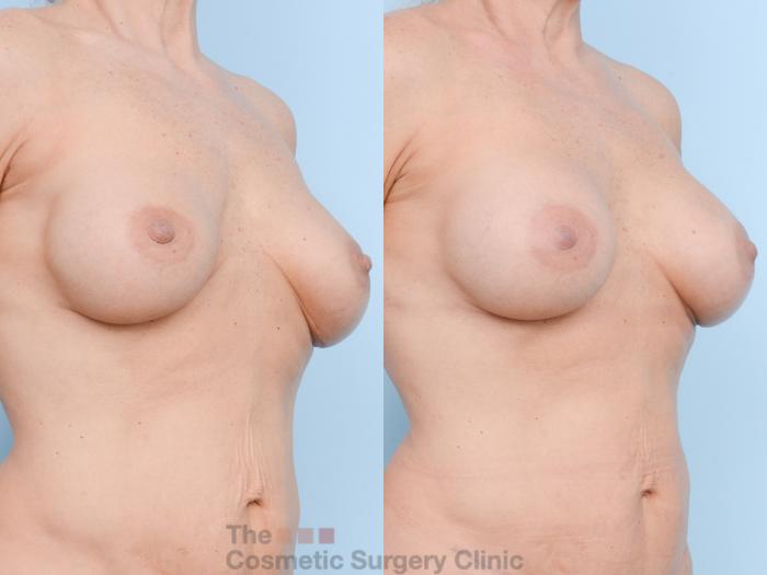 Before & After Breast Revision / Implant Removal Case 802 Right Oblique View in Waterloo, Ontario
