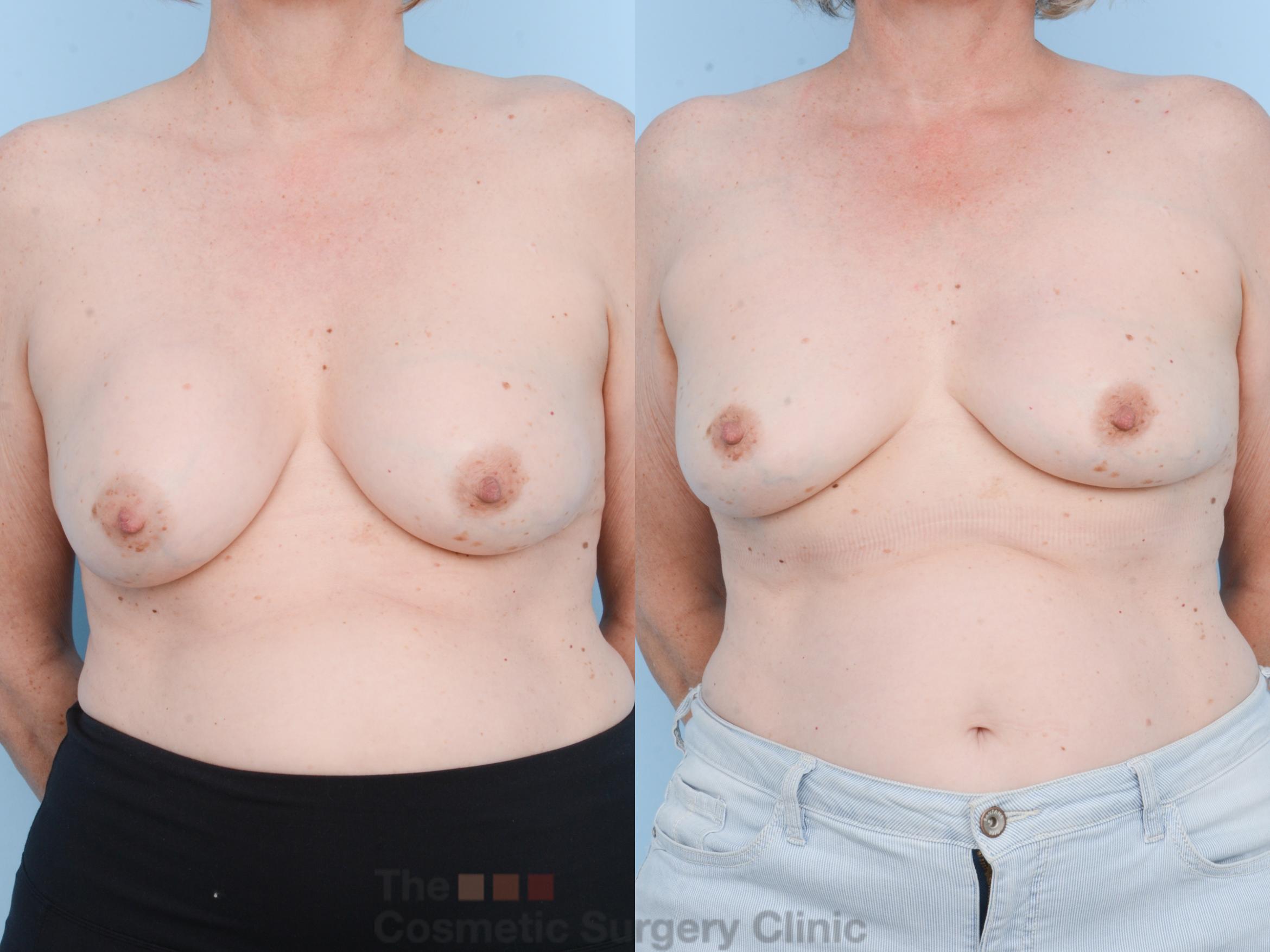Before & After Breast Revision / Implant Removal Case 805 Front View in Waterloo, Ontario