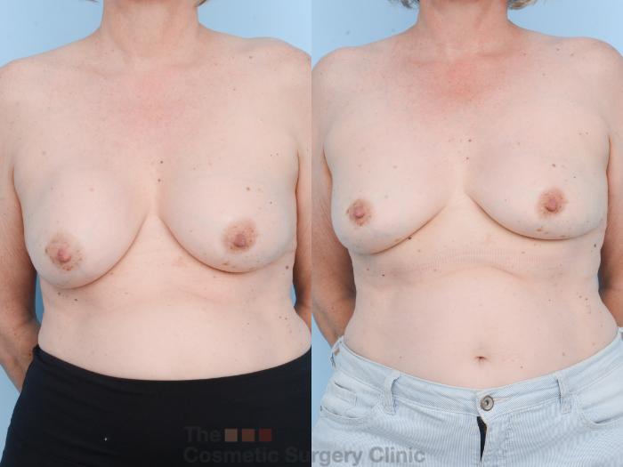Before & After Breast Revision / Implant Removal Case 805 Front View in Waterloo, Ontario