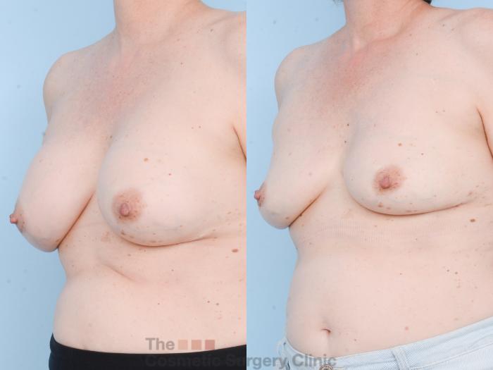 Before & After Breast Revision / Implant Removal Case 805 Left Oblique View in Waterloo, Ontario