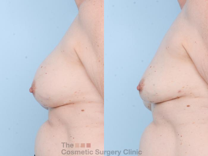 Before & After Breast Revision / Implant Removal Case 805 Left Side View in Waterloo, Ontario