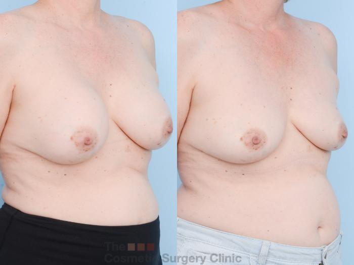 Before & After Breast Revision / Implant Removal Case 805 Right Oblique View in Waterloo, Ontario