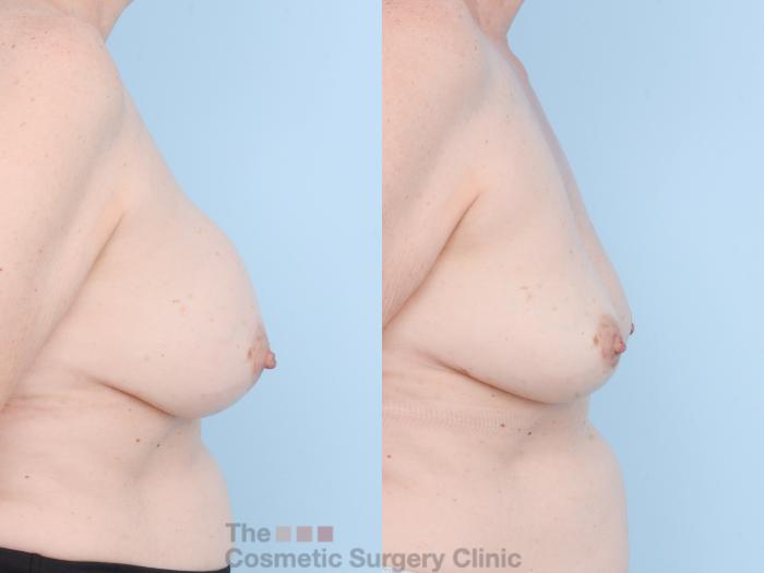 Before & After Breast Revision / Implant Removal Case 805 Right Side View in Waterloo, Ontario