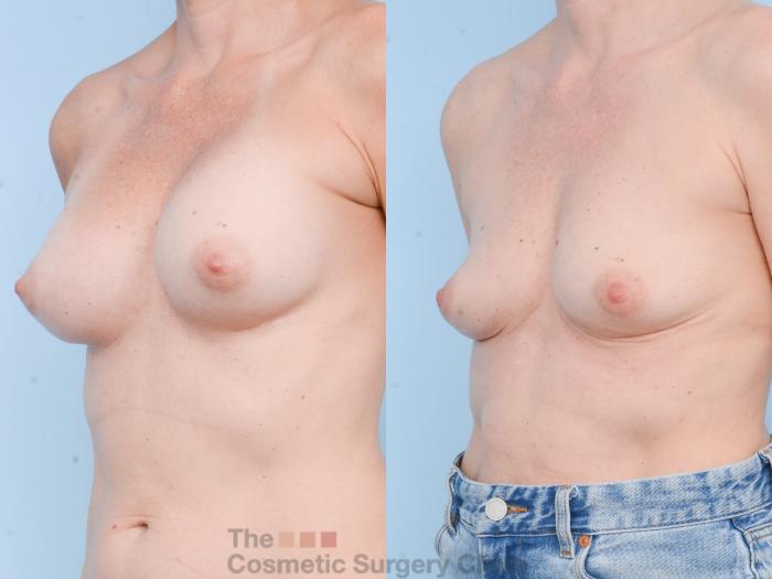 Before & After Breast Revision / Implant Removal Case 811 Left Oblique View in Waterloo, Ontario