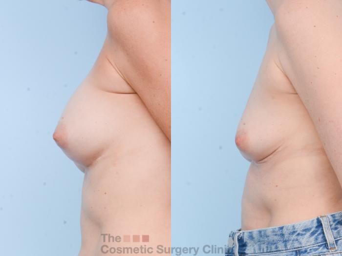 Before & After Breast Revision / Implant Removal Case 811 Left Side View in Waterloo, Ontario