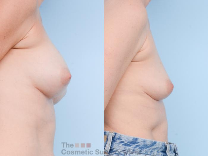 Before & After Breast Revision / Implant Removal Case 811 Right Side View in Waterloo, Ontario