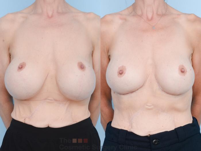 Before & After Breast Revision / Implant Removal Case 830 Front View in Waterloo, Ontario