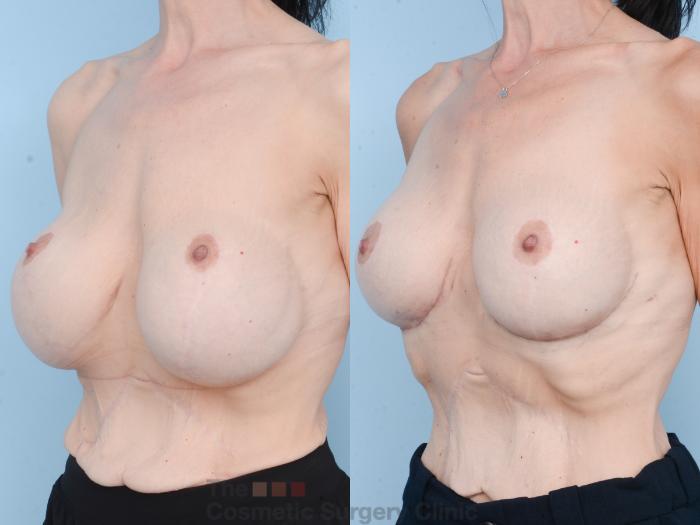 Before & After Breast Revision / Implant Removal Case 830 Left Oblique View in Waterloo, Ontario