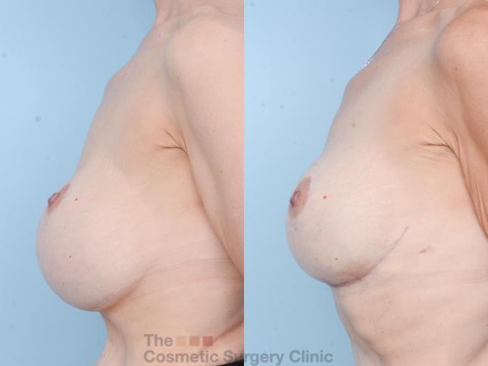 Before & After Breast Revision / Implant Removal Case 830 Left Side View in Waterloo, Ontario
