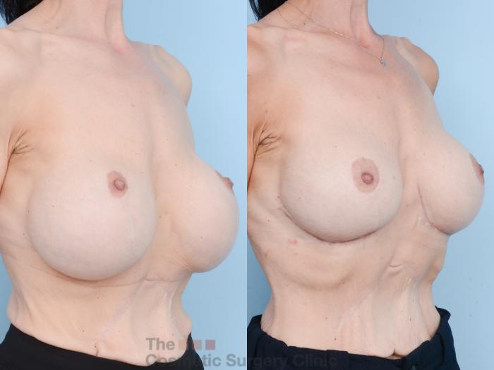 Before & After Breast Revision / Implant Removal Case 830 Right Oblique View in Waterloo, Ontario