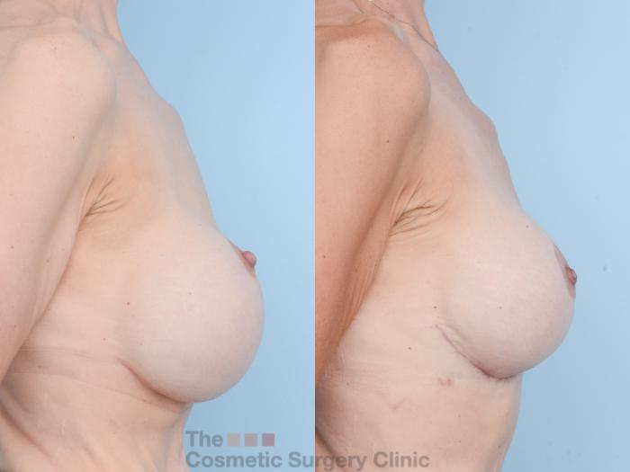 Before & After Breast Revision / Implant Removal Case 830 Right Side View in Waterloo, Ontario