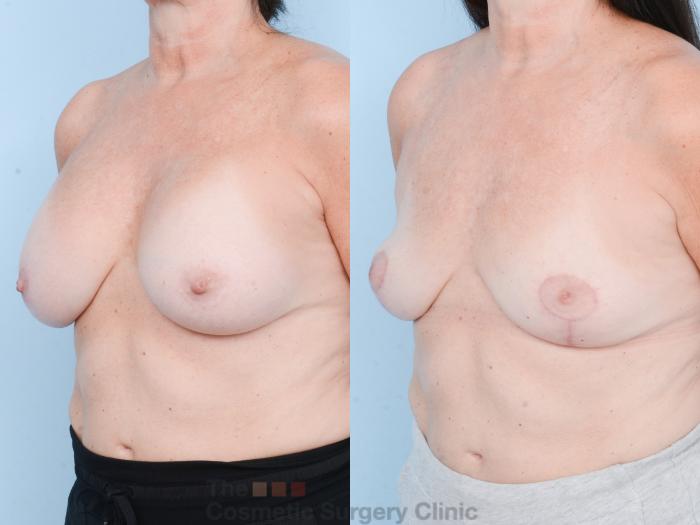 Before & After Breast Revision / Implant Removal Case 836 Left Oblique View in Waterloo, Ontario