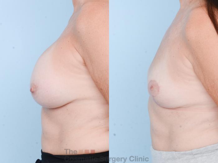 Before & After Breast Revision / Implant Removal Case 836 Left Side View in Waterloo, Ontario
