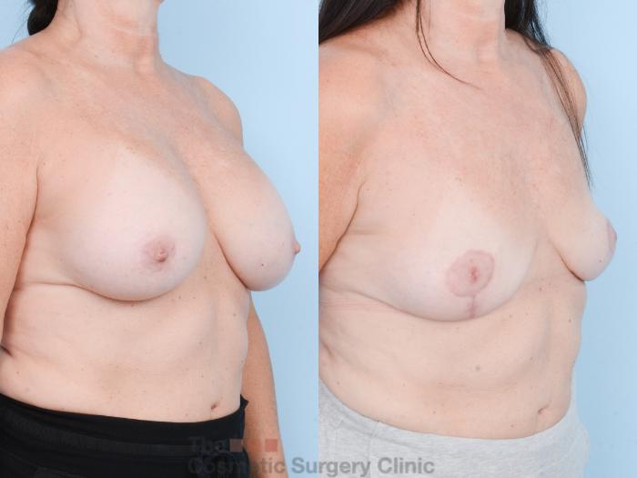 Before & After Breast Revision / Implant Removal Case 836 Right Oblique View in Waterloo, Ontario