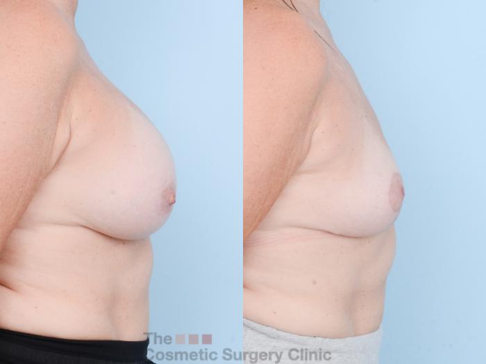 Before & After Breast Revision / Implant Removal Case 836 Right Side View in Waterloo, Ontario