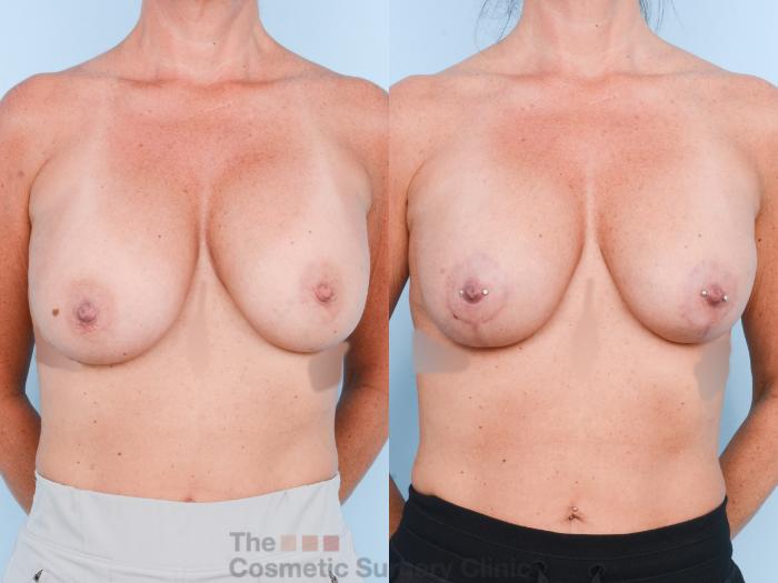 Before & After Breast Revision / Implant Removal Case 847 Front View in Waterloo, Ontario