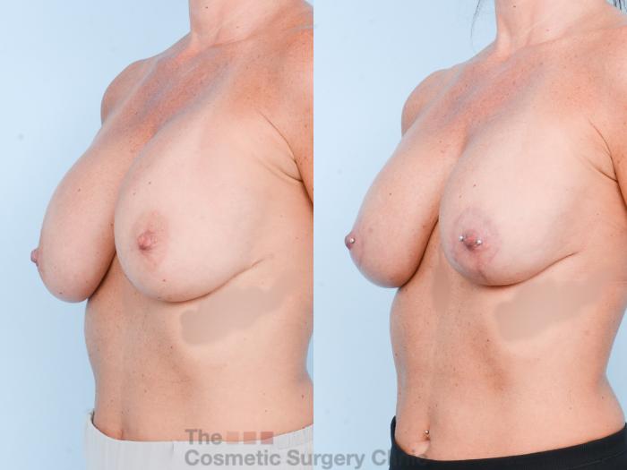 Before & After Breast Revision / Implant Removal Case 847 Left Oblique View in Waterloo, Ontario