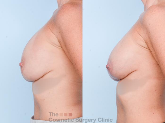 Before & After Breast Revision / Implant Removal Case 847 Left Side View in Waterloo, Ontario
