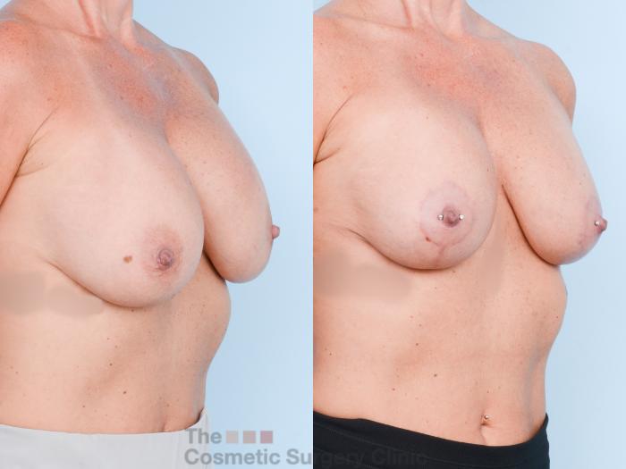 Before & After Breast Revision / Implant Removal Case 847 Right Oblique View in Waterloo, Ontario