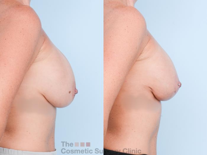 Before & After Breast Revision / Implant Removal Case 847 Right Side View in Waterloo, Ontario
