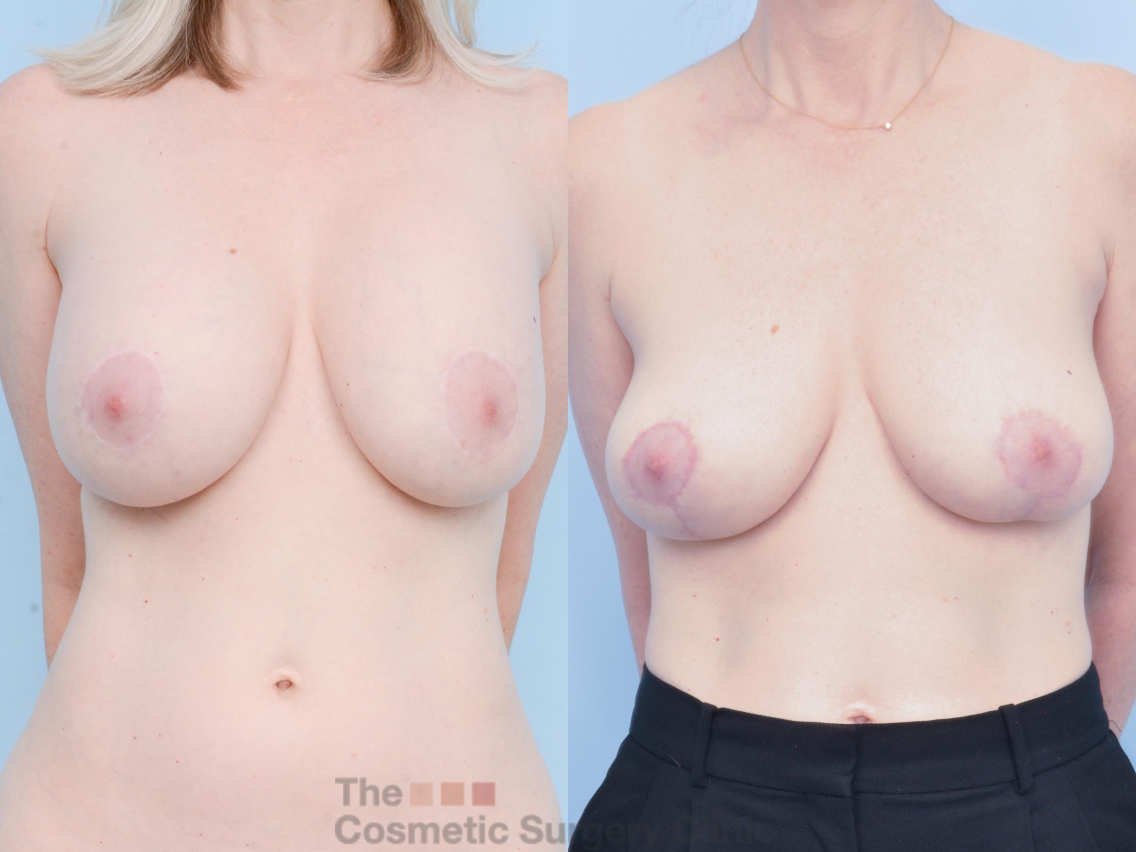 Before & After Breast Revision / Implant Removal Case 882 Front View in Waterloo, Ontario