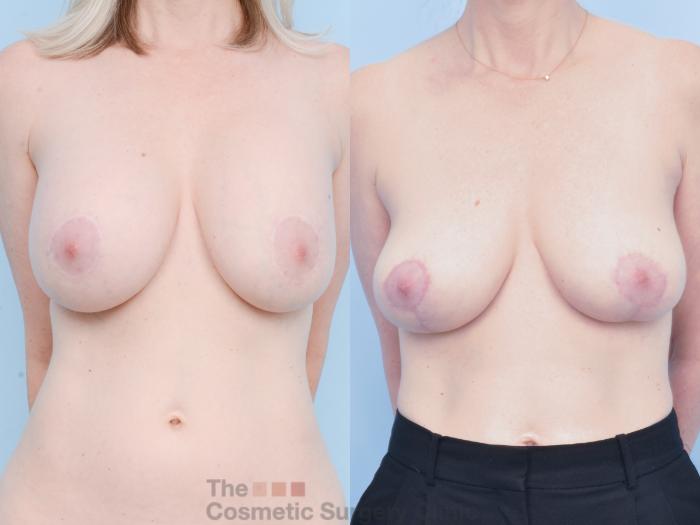 Before & After Breast Revision / Implant Removal Case 882 Front View in Waterloo, Ontario