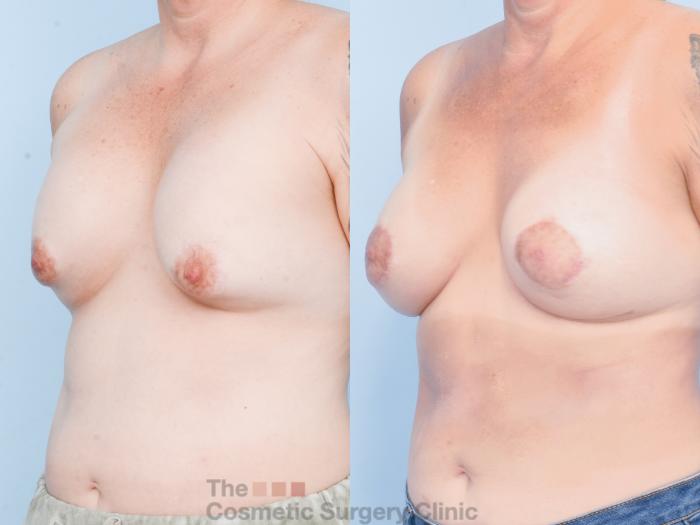 Before & After Breast Revision / Implant Removal Case 883 Left Oblique View in Waterloo, Ontario