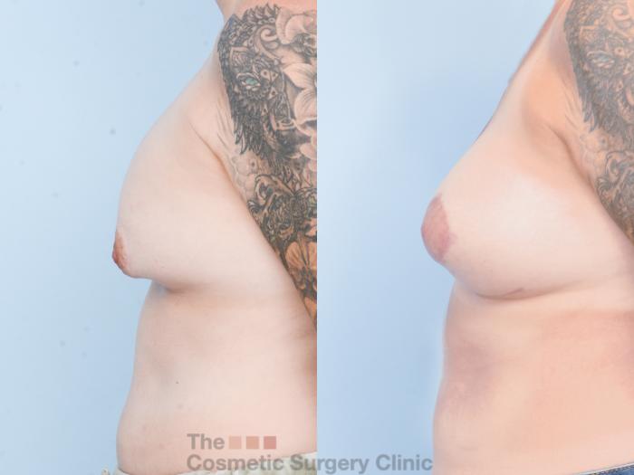Before & After Breast Revision / Implant Removal Case 883 Left Side View in Waterloo, Ontario