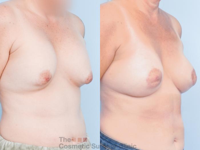 Before & After Breast Revision / Implant Removal Case 883 Right Oblique View in Waterloo, Ontario