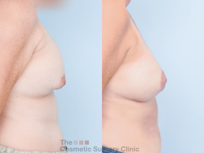 Before & After Breast Revision / Implant Removal Case 883 Right Side View in Waterloo, Ontario