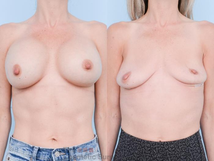Before & After Breast Revision / Implant Removal Case 891 Front View in Waterloo, Ontario