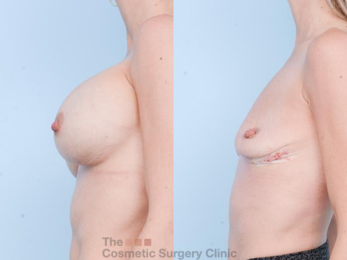 Before & After Breast Revision / Implant Removal Case 891 Left Side View in Waterloo, Ontario