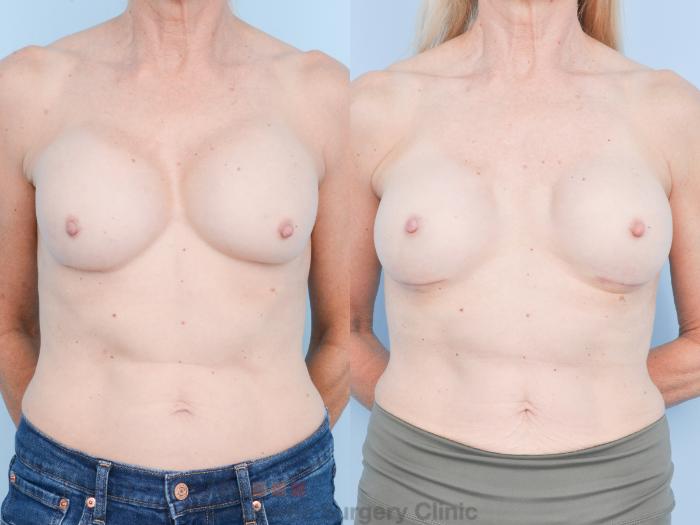 Before & After Breast Revision / Implant Removal Case 893 Front View in Waterloo, Ontario