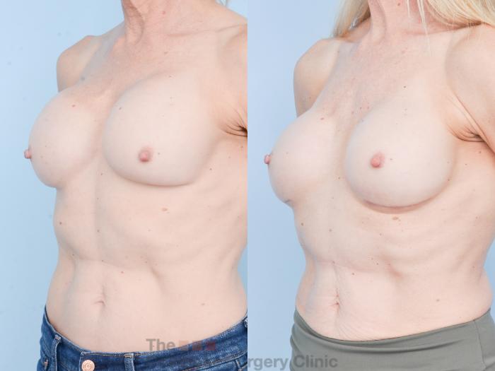 Before & After Breast Revision / Implant Removal Case 893 Left Oblique View in Waterloo, Ontario
